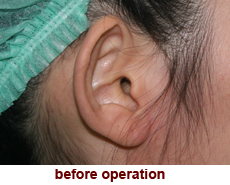 plastic-surgery-prominent-ear 